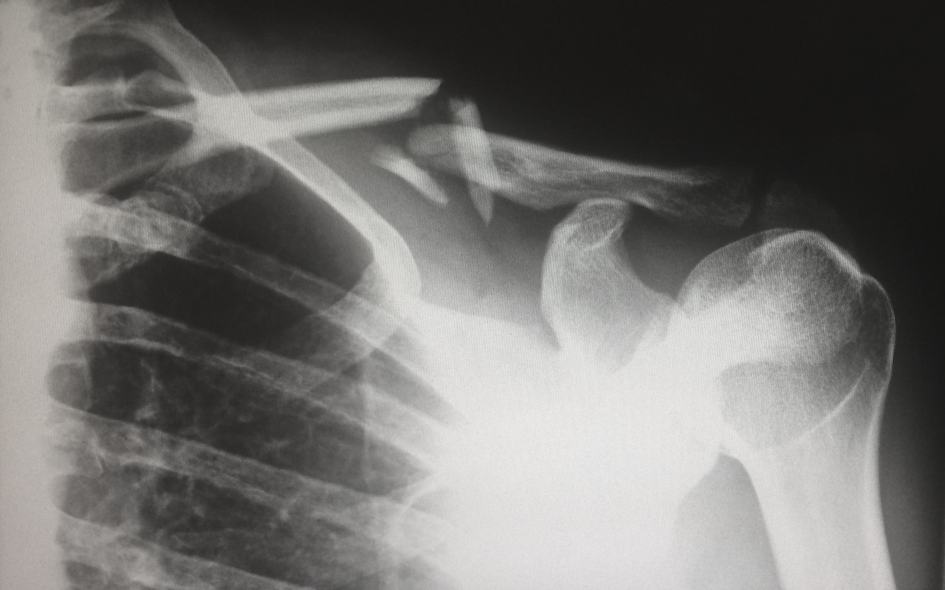 injury broken bone collar bone xray athlete heal